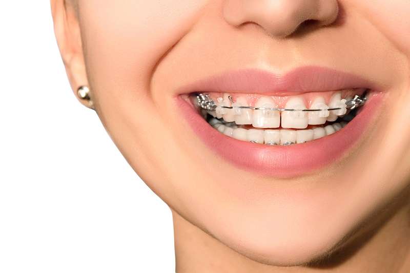5 Myths About Orthodontic Treatments